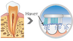 Устранение зубного налета